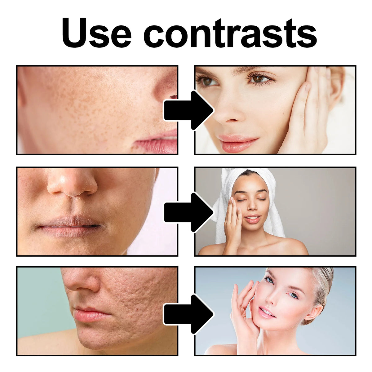 West&Month Exfoliating Peeling Gel - 50g Acne & Blackhead Treatment