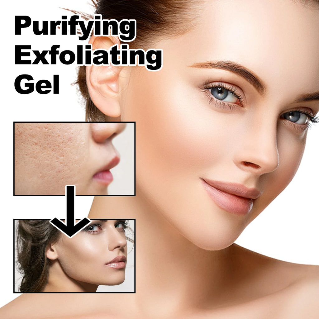 West&Month Exfoliating Peeling Gel - 50g Acne & Blackhead Treatment