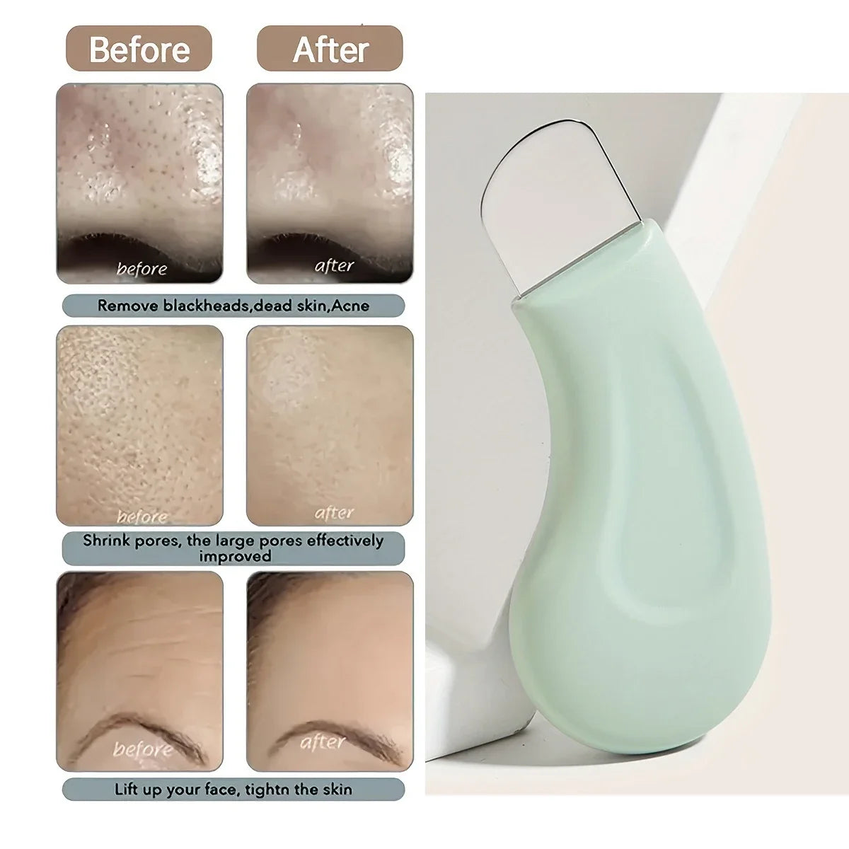Blackhead And Whitehead Removal Tool For Nose And Face - Skin Pore Cleaner Skin Care Tools For Women'S