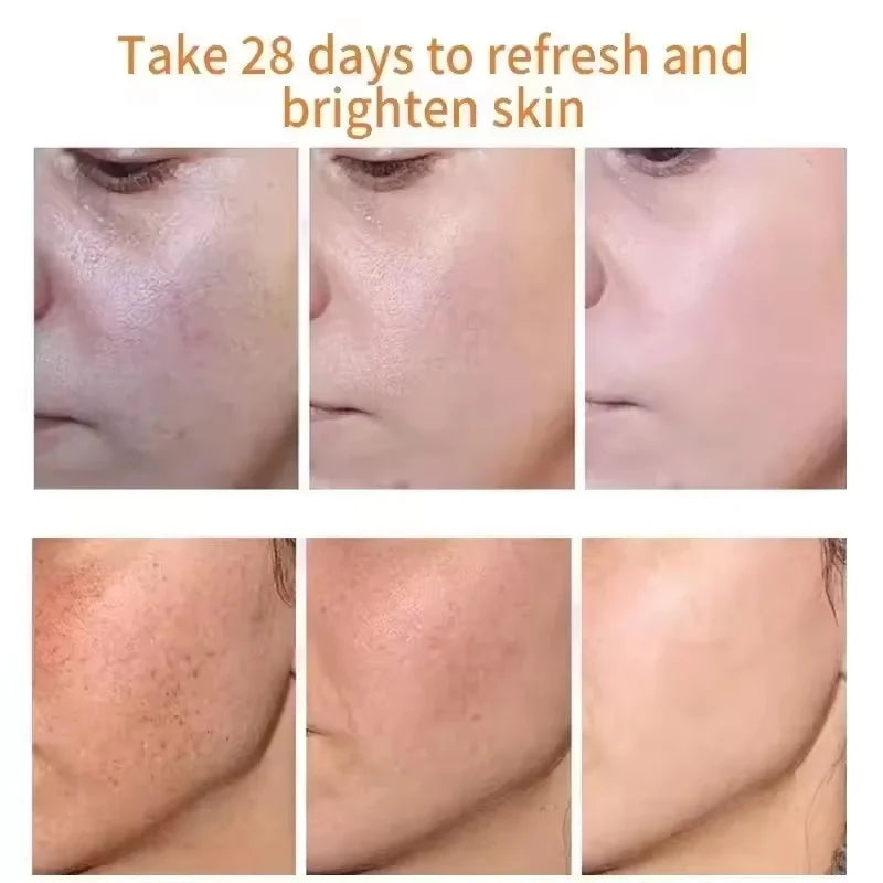 Niacinamide Dark Spot Remove Serum Face Freckle Melanin Correcting Moisturizing Brightening Anti Pigmentation Repair Skin Care