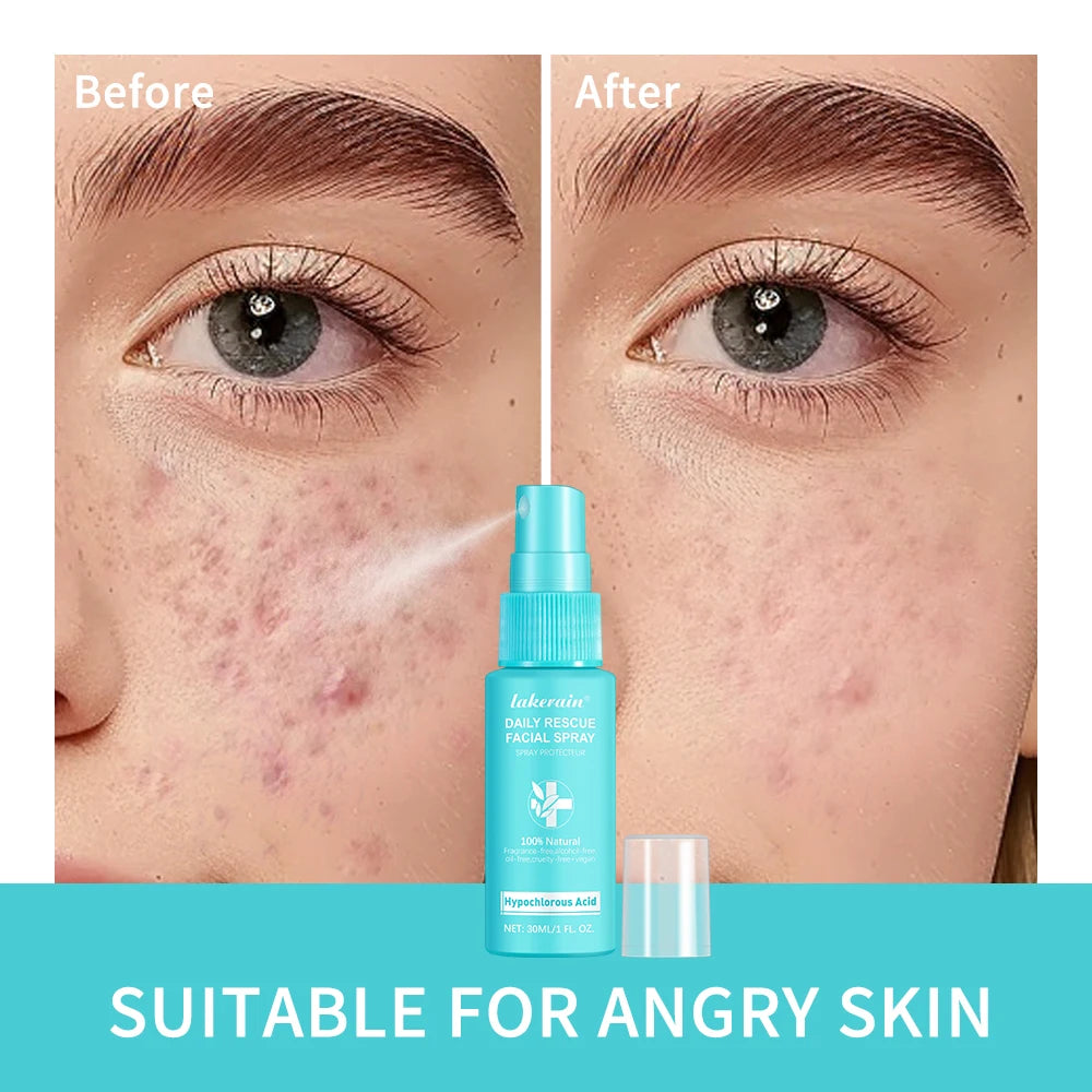 PH Balancing Toner Daily Rescue Facial Spray for Sensitive Skin Hypochlorous Acid Spray Helps Reduce Redness Breakouts Soothing