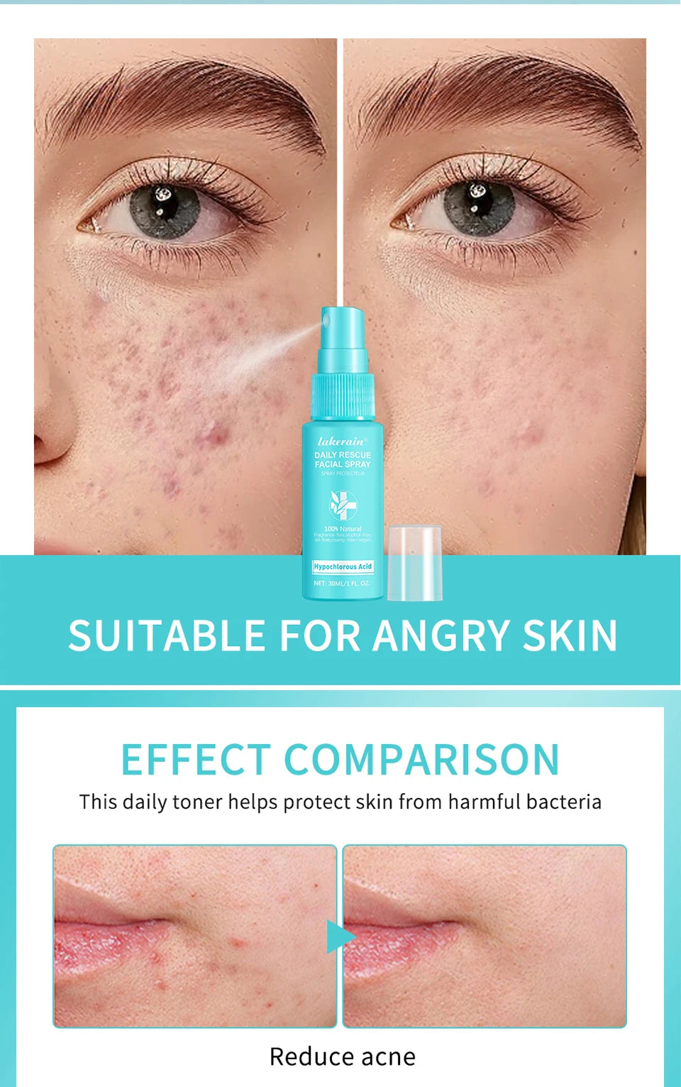 PH Balancing Toner Daily Rescue Facial Spray for Sensitive Skin Hypochlorous Acid Spray Helps Reduce Redness Breakouts Soothing