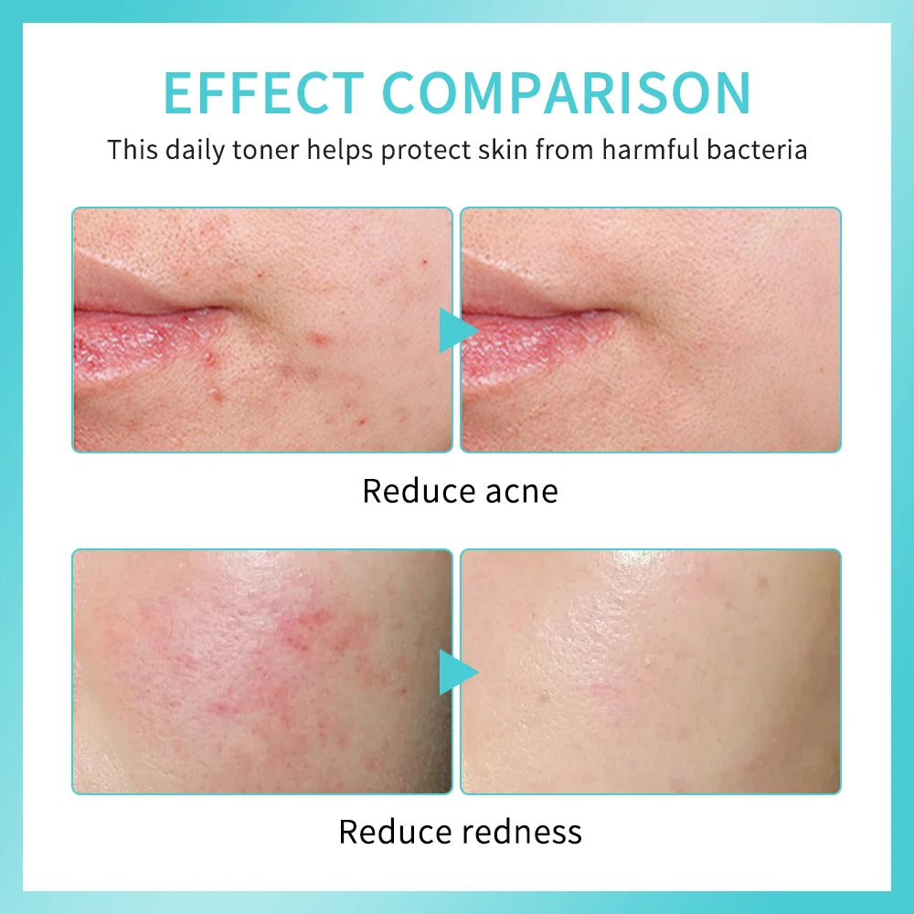 PH Balancing Toner Daily Rescue Facial Spray for Sensitive Skin Hypochlorous Acid Spray Helps Reduce Redness Breakouts Soothing
