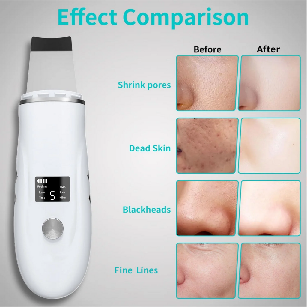 Ultrasonic Skin Scrubber Blackhead Remover Peeling Pore Cleaner Face Cleaning Blackhead Removal Shovel Face Deep Cleaning Device